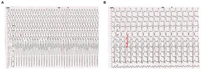 Case Report: A Novel Variant c.2262+3A>T of the SCN5A Gene Results in Intron Retention Associated With Incessant Ventricular Tachycardias